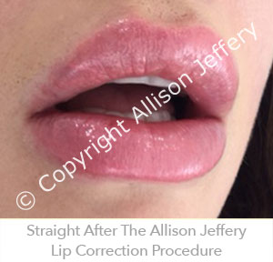 Result 1 after Designer Lip Shaping by Allison Jeffery, Brighton