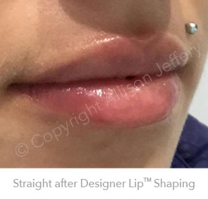 Result 5 after Designer Lip Shaping by Allison Jeffery, Brighton